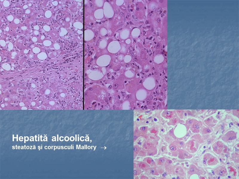 Hepatită alcoolică, steatoză şi corpusculi Mallory  